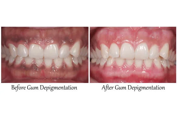 Gum Depigmentation
